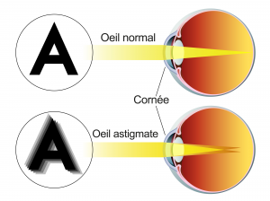 L'oeil astigmate