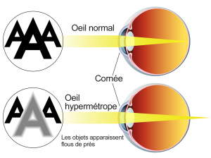 L'oeil hypermétrope